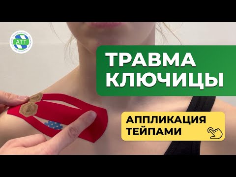 Видео: Перелом ключицы  Тейпирование ключицы  Травма ключицы 1