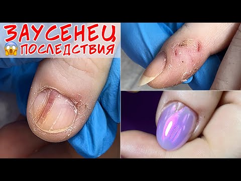 Видео: Загноился заусенец / Панариций последствия 😓