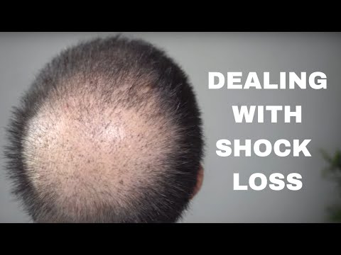 Видео: Шоковое выпадение волос после пересадки волос (и как с этим справиться)