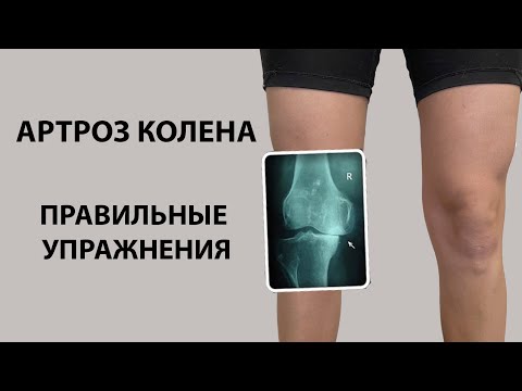 Видео: Гимнастика при артрозе коленного сустава. Упражнения для разработки и укрепления колена.