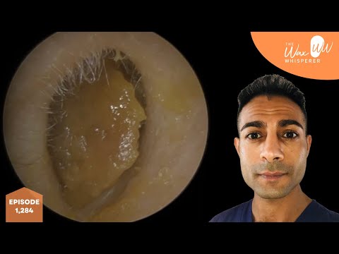 Видео: 1,284 - x2 видео об удалении ушной серы