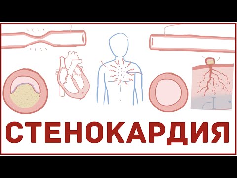 Видео: Стенокардия кратко - виды, причины, симптомы, лечение