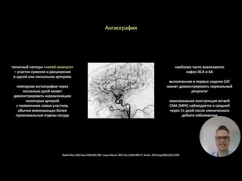 Видео: Синдром обратимой церебральной вазоконстрикции. д.м.н., проф. Кулеш Алексей Александрович