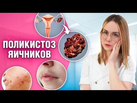 Видео: Вся правда о поликистозе яичников: Виды, причины, риски и лечение!