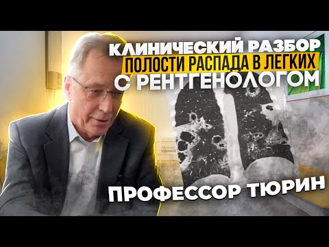 Видео: Клинические разборы с рентгенологом. Профессор Тюрин. Полости распада в легких.