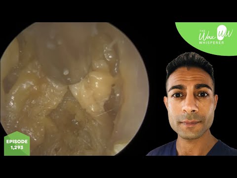 Видео: 1,293 - Комплексное удаление и отшелушивание омертвевших клеток кожи