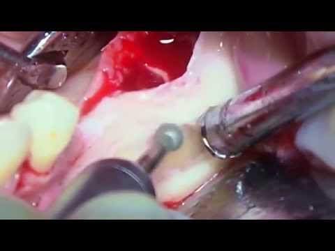 Видео: Экстрация ретинированных зубов нижней челюсти.