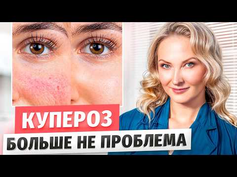 Видео: Как избавиться от сосудов на лице? Лечение КУПЕРОЗА и РОЗАЦЕА - Вены под глазами