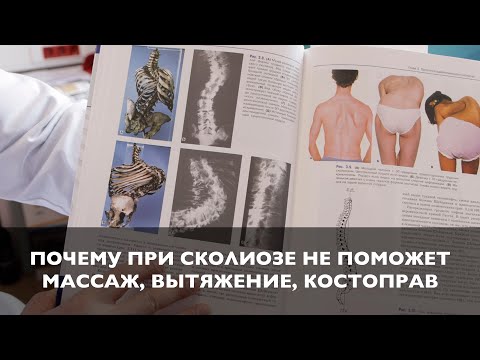 Видео: Почему при идиопатическом сколиозе 3 и 4 степени не поможет костоправ, массаж, плавание и упражнения