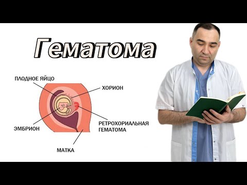 Видео: ЖҮКТІЛІК кезде ГЕМАТОМА пайда болса не істеу қажет.Гематома деген не?ГЕМАТОМА ҚАУІПТІ МЕ?