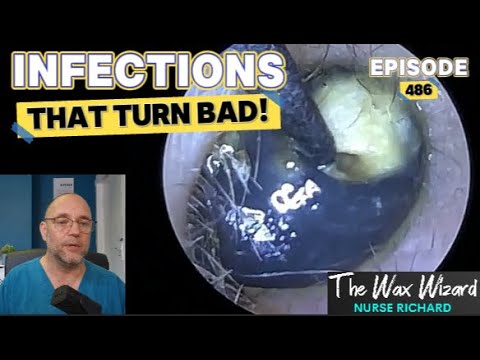Видео: ИНФЕКЦИИ, КОТОРЫЕ ПРИВОДЯТ К ПЛОХИМ БОЛЕЗНЯМ! Эпизод 486 (3 инфекции и инородное тело!)