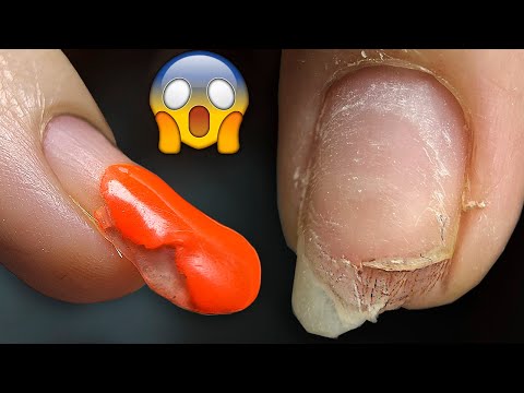 Видео: Ногти из БУМАГИ?😱 После ДРУГОГО МАСТЕРА. НЕправильное НАРВАЩИВАНИЕ Ногтей. ПОСЛЕДСТВИЯ. через 10 лет