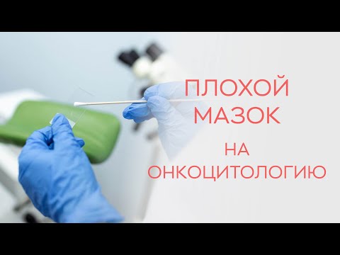 Видео: 🧫 Что делать, если мазок на онкоцитологию плохой?