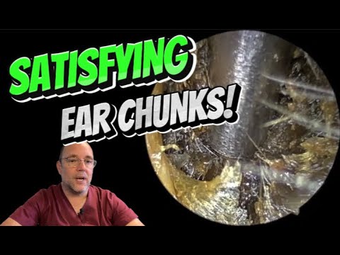 Видео: УДОВЛЕТВОРИТЕЛЬНЫЕ ЧАСТИКИ ДЛЯ УШЕЙ! 297 #ухо #ушнаясера #удалениеушнойсеры #чисткаушей #fyp #asm...
