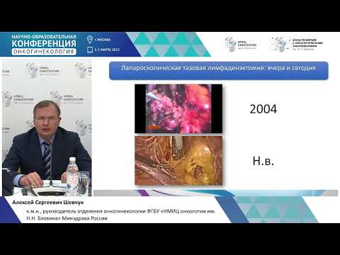 Видео: Хирургия рака тела матки: вчера, сегодня завтра. Шевчук А.С.