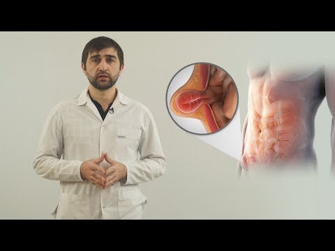 Видео: Паховая грыжа