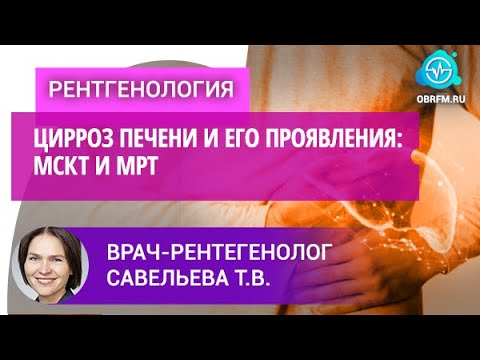Видео: Врач-рентгенолог Савельева Т.В.: Цирроз печени и его проявления: МСКТ и МРТ