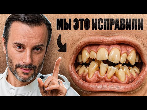 Видео: Что делают брекеты с лицом спустя 10 лет после лечения. Последствия брекетов спустя 10 лет