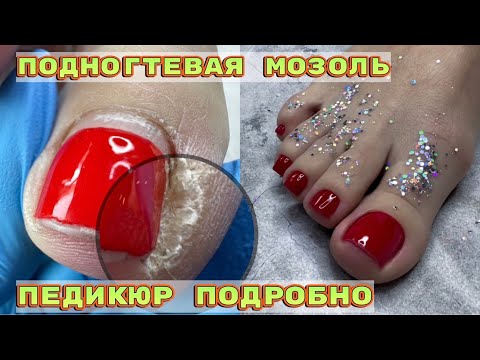 Видео: Как удалить подногтевую мозоль 🦶Педикюр подробно