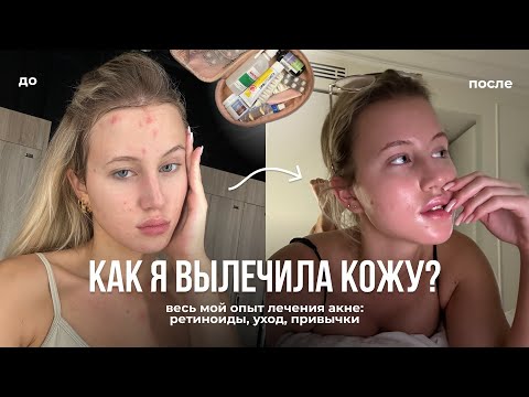 Видео: ВЕСЬ МОЙ ПУТЬ БОРЬБЫ С АКНЕ / как я вылечила кожу?