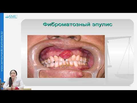 Видео: ПАРОДОНТОМЫ