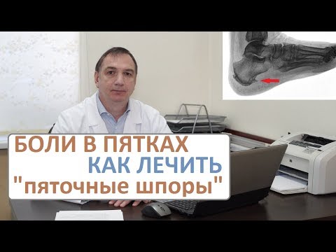 Видео: Боли в пятках, лечение. Пяточные шпоры - как их лечить.