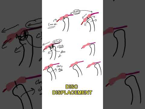 Видео: Смещение диска ВНЧС | Вывих диска с вправлением | Вывих диска без вправления