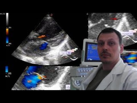 Видео: Детская ЭхоКГ - Некомпакт и клапанные регургитации