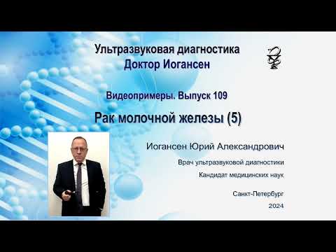 Видео: Ультразвуковая диагностика. Доктор Иогансен. Видеопримеры. Выпуск 109. Рак молочной железы (5).