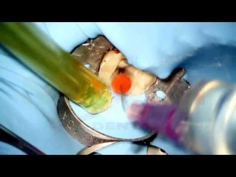 Видео: Препарирование корневых каналов второго нижнего моляра инструментом Reciproc