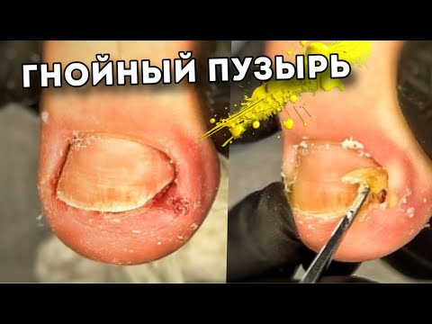 Видео: Гнойный экссудат при вросшем ногте #подологтатьянапак #ingrown_toenail_surgery