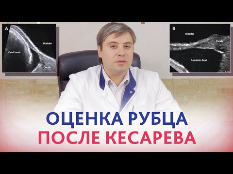 Видео: Рубец после кесарева. Ультразвуковая оценка рубца на матке после кесарева сечения.  Курганников А.С.