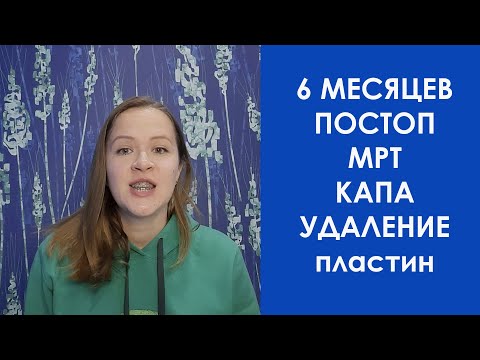 Видео: Зубные новости. 6 мес ПОСТОП. МРТ, капа, удаление пластин, имплант