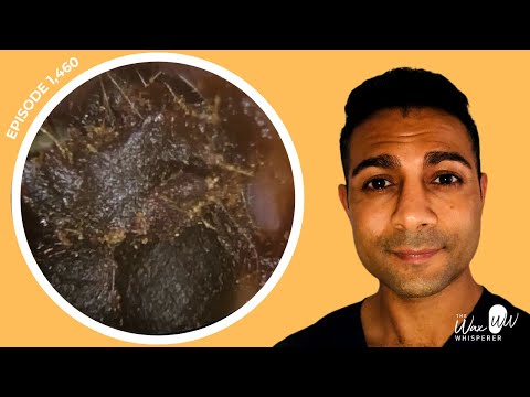 Видео: 1460 - Церумэктомия уплотнённой тёмной и плотной ушной серы с использованием кюретки Rai и микроо...