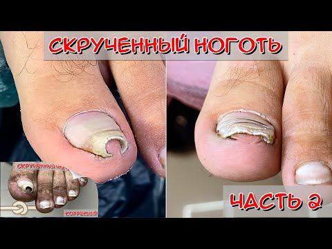 Видео: Скрученные ногти - "Капитан Аэро" (Часть 2) / Коррекционная система титановая нить