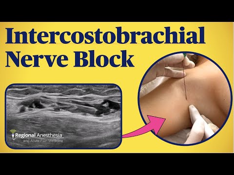 Видео: Блокада межреберно-плечевого нерва с помощью УЗИ и ориентиров