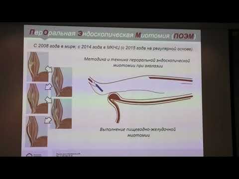 Видео: 01 Шишин КВ Дивертикул Ценкера Ахалазия Кардии