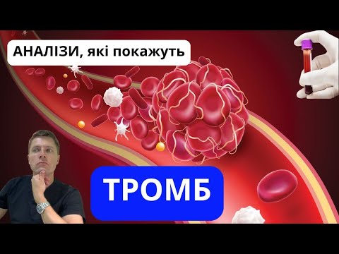 Видео: Як виявити у себе ТРОМБ? Що треба зробити для профілактики тромбозу?