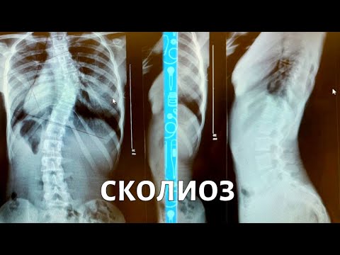 Видео: СКОЛИОЗ. Как выбрать лучшие методы лечения