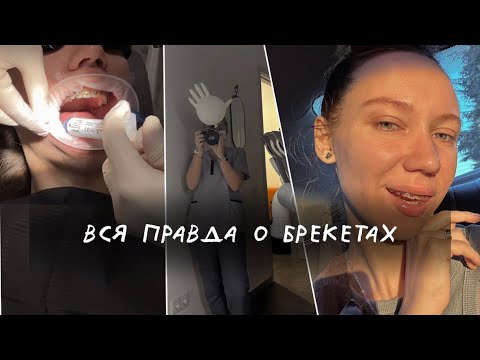 Видео: брекеты влог | о чём все молчат | цена, боль, отвечаю на вопросы