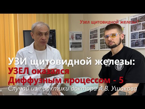 Видео: УЗИ щитовидной железы: Как узисты приняли сегмент за Узел // Доктор Ушаков