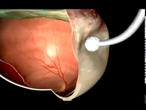 Видео: Отслойка сетчатки глаза