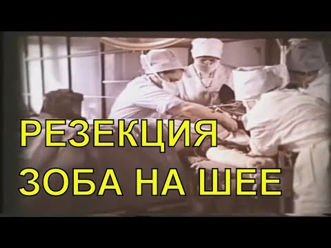 Видео: Резекция зоба на шее © Resection of goiter on the neck