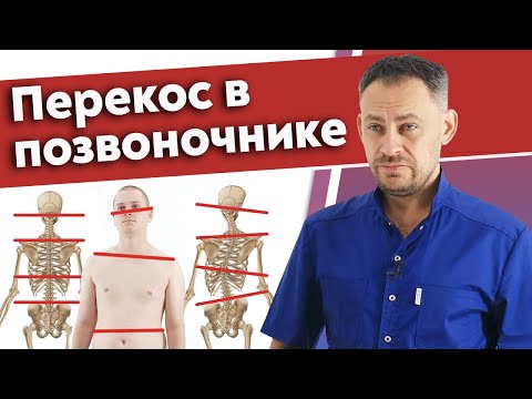Видео: Что такое сколиоз позвоночника? / Какие последствия будут, если не лечить перекос позвоночника?