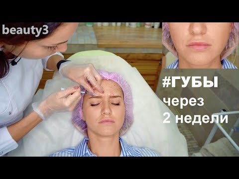 Видео: Инъекции ботокс +  результат увеличения губ (через 2 недели)