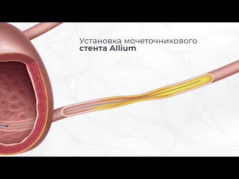 Видео: Установка мочеточникового стента Allium