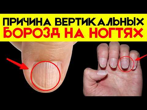 Видео: У вас есть вертикальные гребни на ногтях? Вот что они означают!
