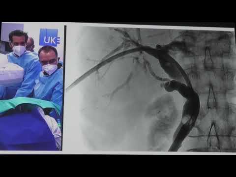 Видео: 31 Live Enoclub Nord P Dautel & G Schachschal Дренирование желчных протоков на отключенной ДПК после