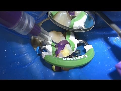 Видео: Адгезивный протокол мини версия