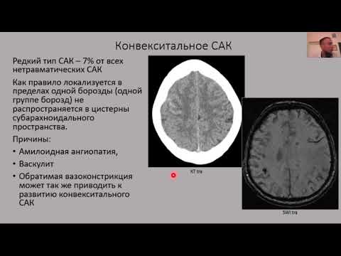 Видео: МР-диагностика: субарахноидальные кровоизлияния, аневризмы, инсульт, сосудистая мальформация.